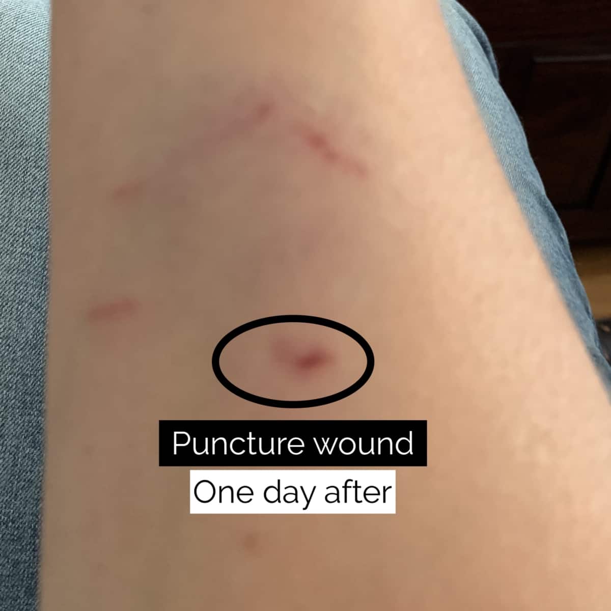 wound day 1